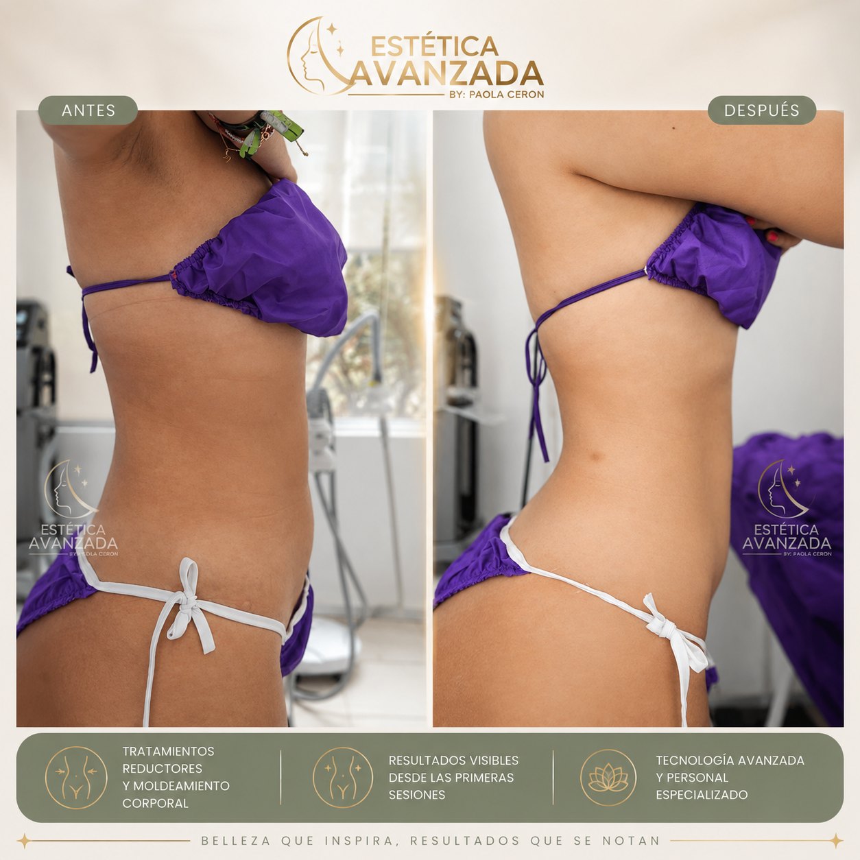 Antes y después de tratamiento reductor de abdomen
