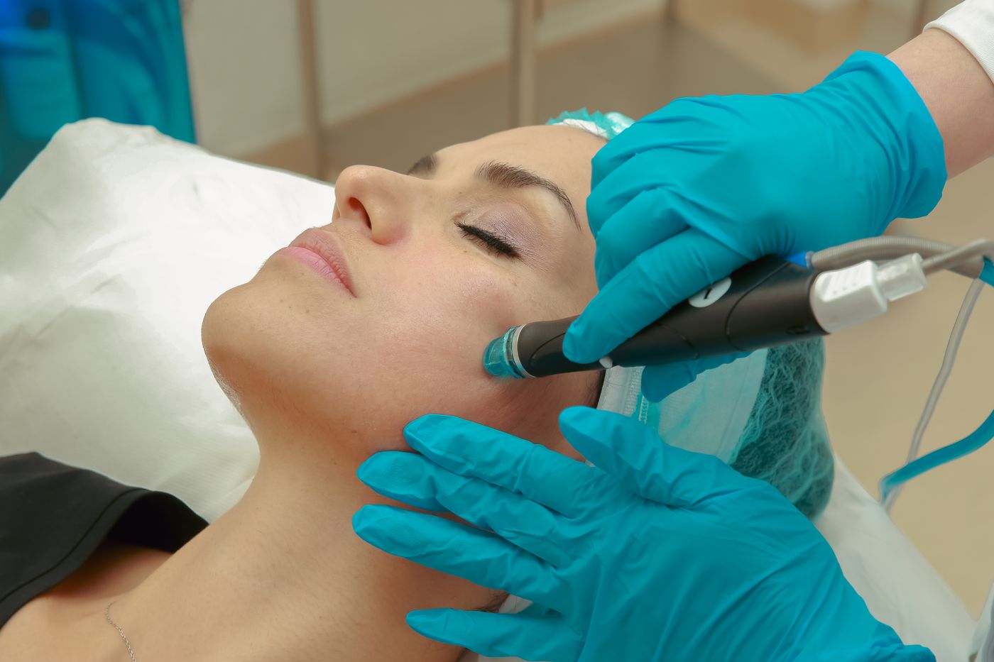 Tratamiento con dermapen